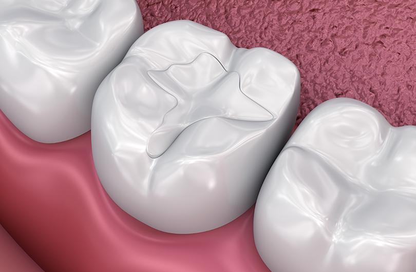 Composite Fillings - Repair and fill cavities